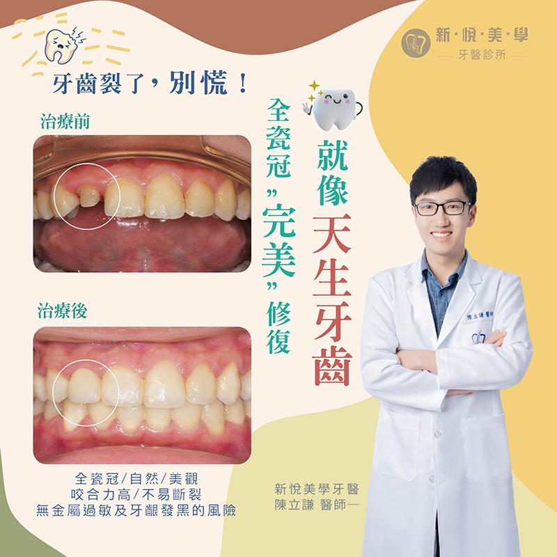 牙齒裂了，別慌！的第1張圖片